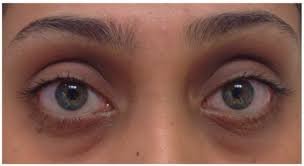thyroid eye disease