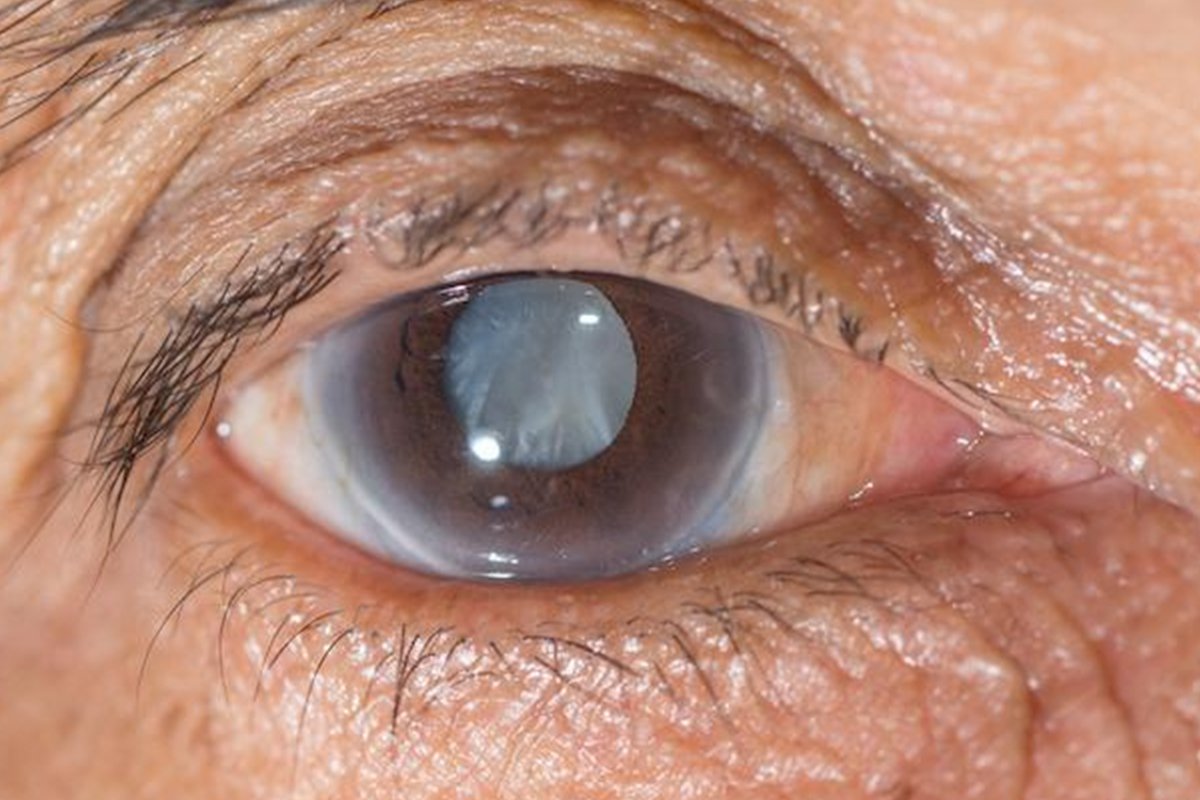 Cataract Eye Surgery