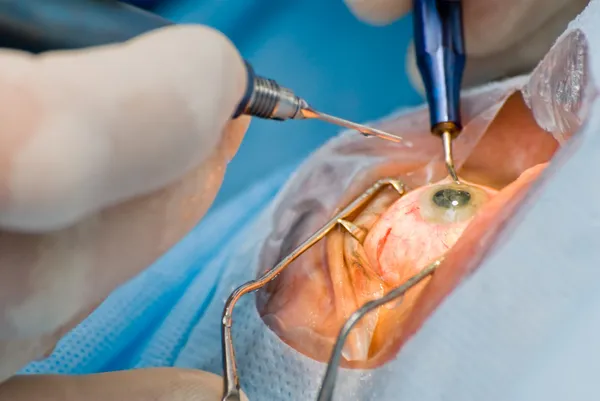 cataract surgery in Bangalore