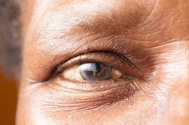 cataract surgery in bangalore