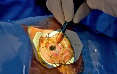 cataract operation cost in bangalore