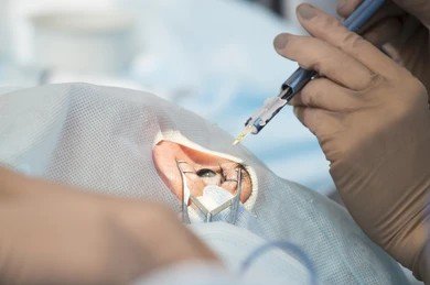 laser eye surgery in Bangalore