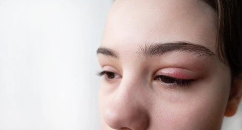 swollen eye