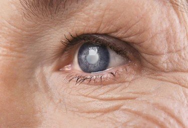 cataract surgery in bangalore