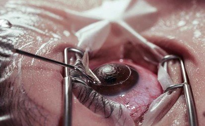 lasik eye surgery in Bangalore